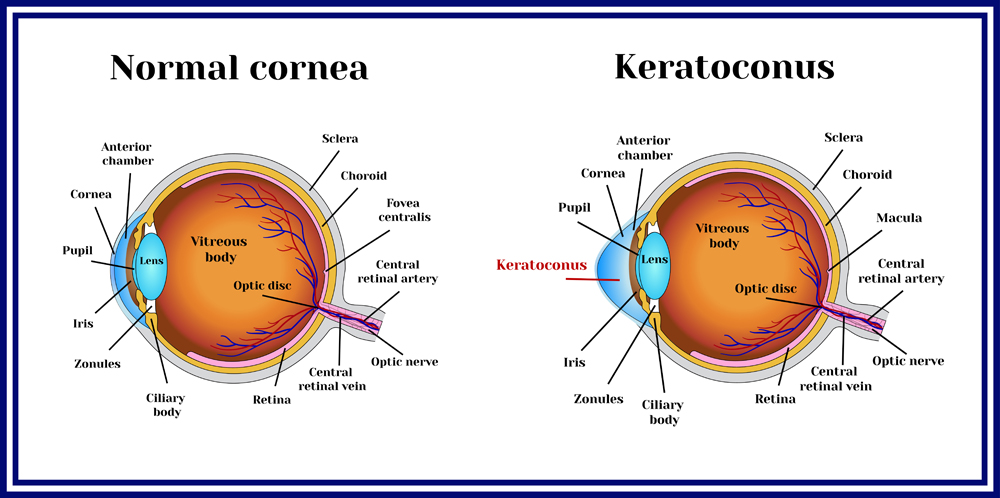 Keratoconus Treatment